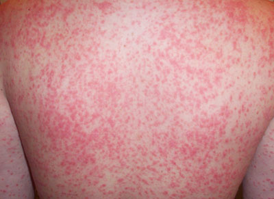 Psoriasis