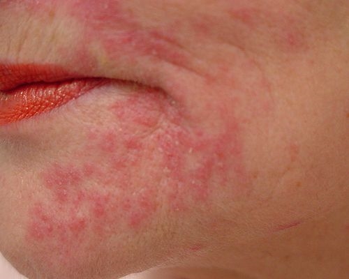 Wie sieht eine Dermatitis aus?