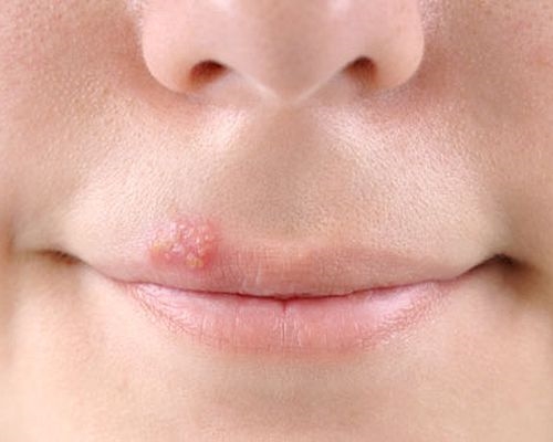 Wie sieht Herpes aus?