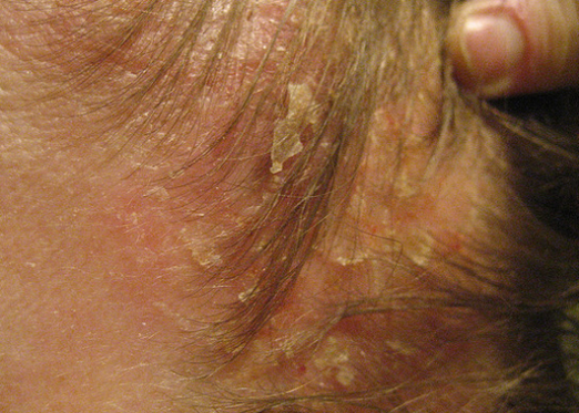 Wie man seborrhoische Dermatitis kuriert?