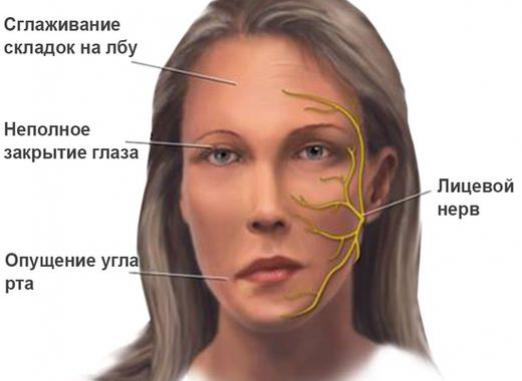 Was ist Myasthenia gravis?